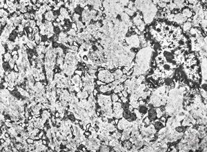 M, 44y. | Gaucher disease … spleen M, 44y. | Gaucher disease … spleen